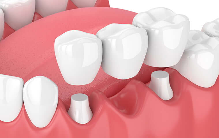 illustration of a dental bridge