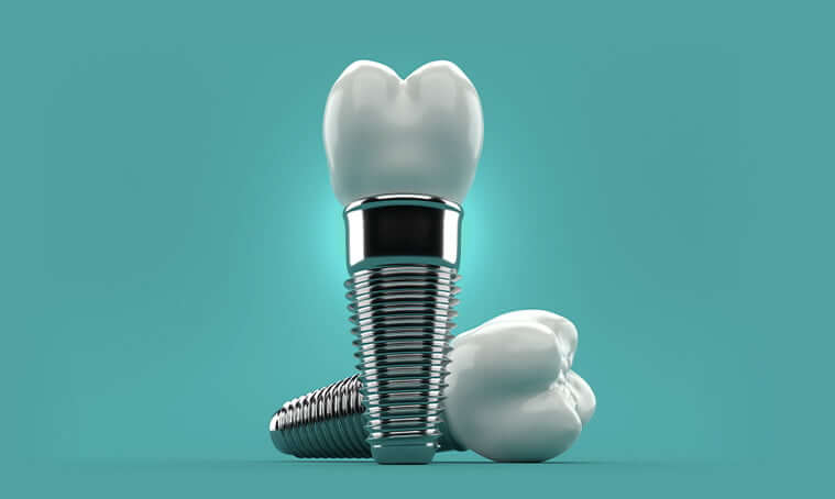 illustration of dental implants