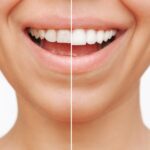 dental veneers in Houston, TX