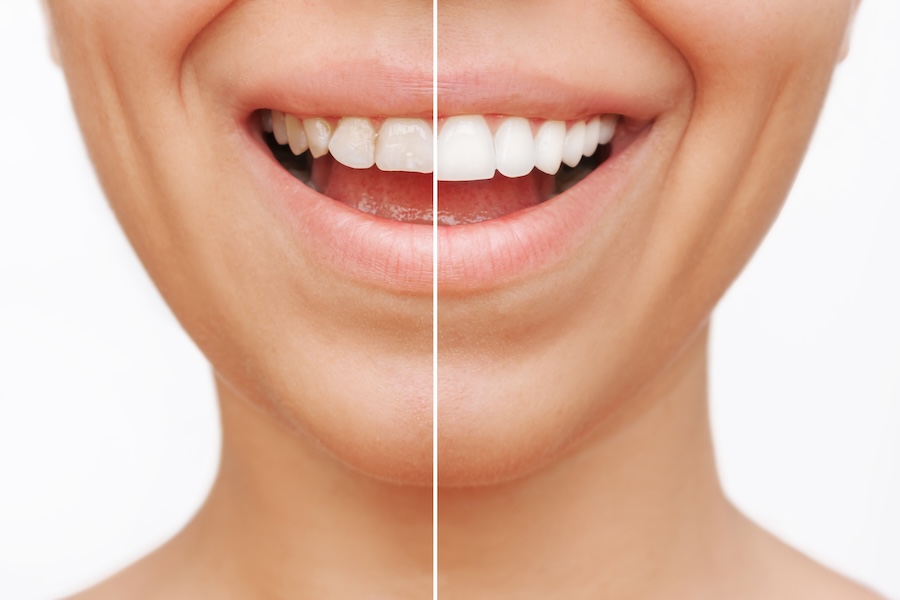 dental veneers in Houston, TX